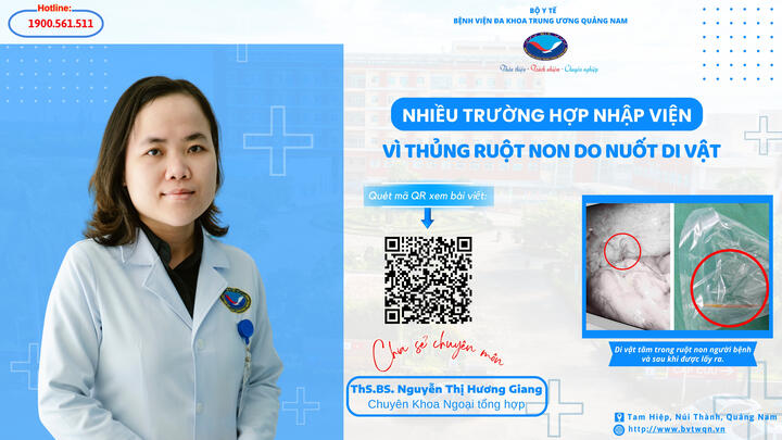 Nhiều trường hợp nhập viện vì thủng ruột non do nuốt di vật