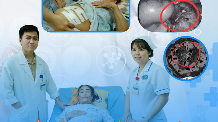 Gắp thành công mảnh xương cá đâm thủng ruột non người bệnh nữ 68 tuổi