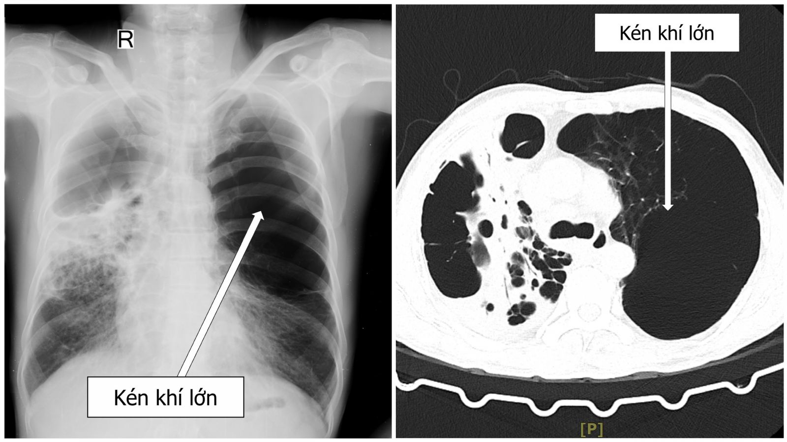 Triệu chứng của kén khí phổi